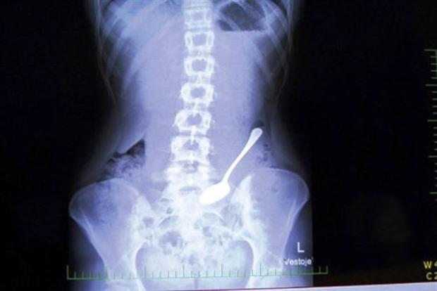 Ameliyat sonrası hastanın karnında makas ve hatta alyansını unutan doktorlar... Vücudunun içinde el bombası taşıyanlar...