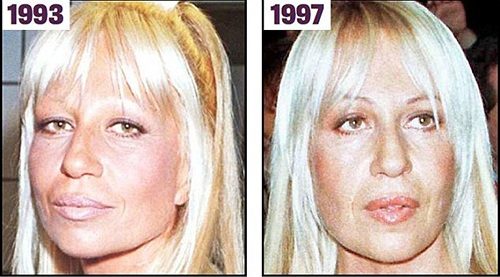 Tasarımları moda dünyasında çığır açan modacının cildi, geçirdiği estetik operasyonlar ve yaptırdığı botokslar sonucu korkunç bir hale büründü.