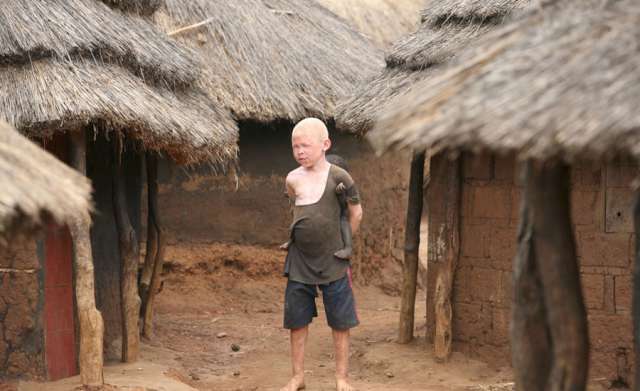 tanzanya-da-albino-cinayeti-tanzanya-albino-1477747.jpg