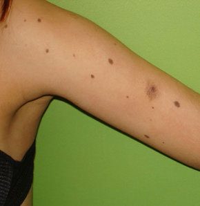 El ve yüz gibi güneşe açık alanların yanı sıra genital bölgedeki benler açısından da dikkatli olunması gerektiğini vurgulayan Akyol, "Çok sayıda beni bulunan kişilerde, bu benlerden herhangi birinin, 'melanom' adı verilen deri tümörü yönünde gelişim gösterme riski yüksektir. Çok fazla bene sahip olmak düzenli bir tıbbi takibi gerektirir" diye konuştu.