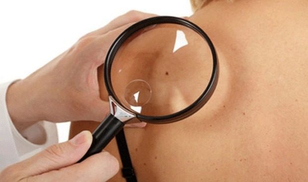 Cumhuriyet Üniversitesi (CÜ) Tıp Fakültesi Dermatoloji Anabilim Dalı Öğretim Üyesi Prof. Dr. Melih Akyol, çok fazla beni bulunan kişilerin deri tümörüne yakalanma riskinin yüksek olduğunu söyledi.