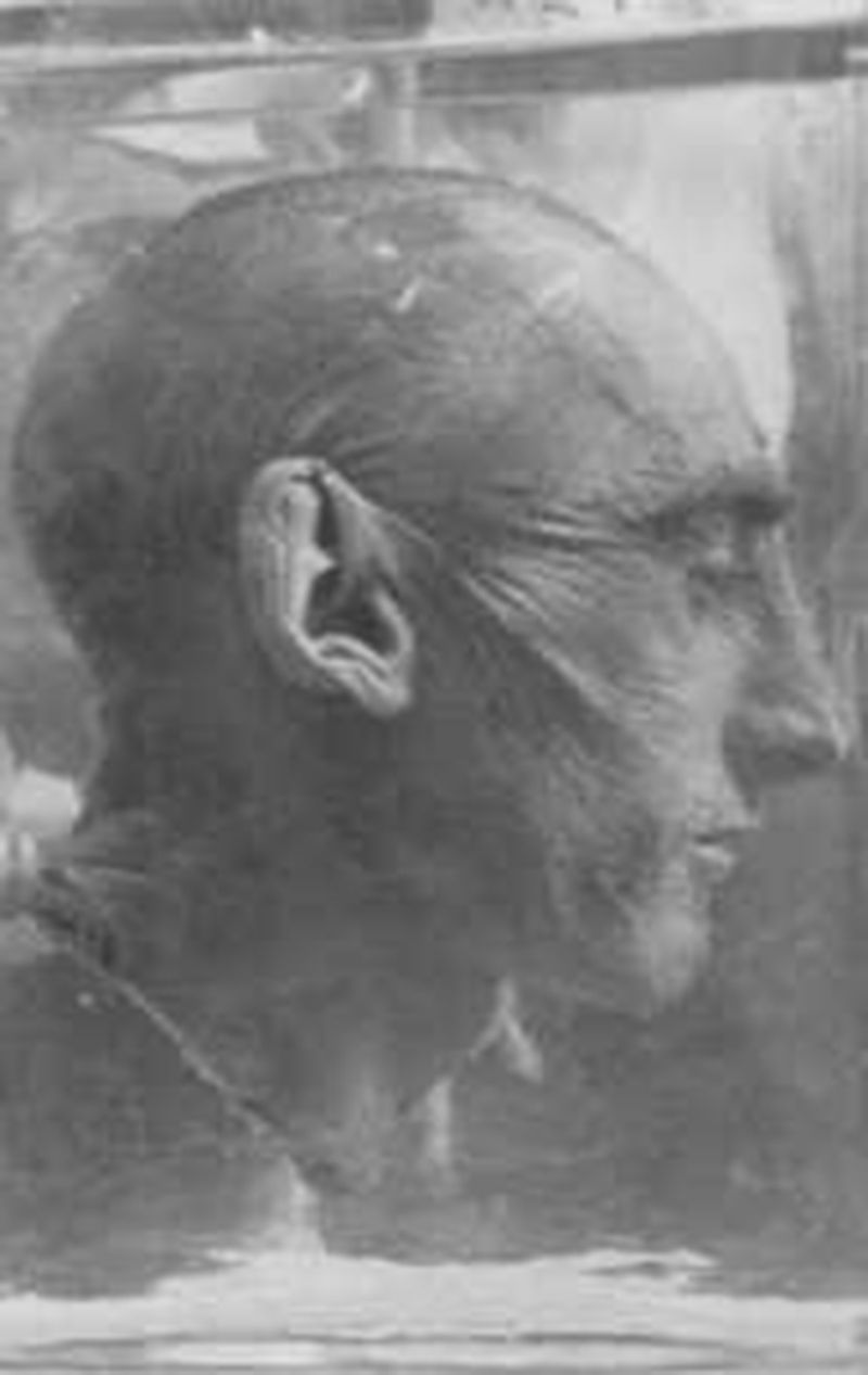 Nazi tıbbî deneylerinin kurbanlarından biri.