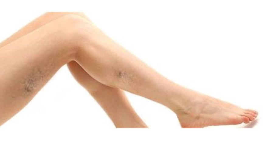 varis tedavisinde en etkili yontem