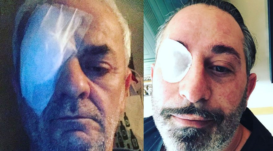 Cem Yılmaz’ın gözüne ne oldu?