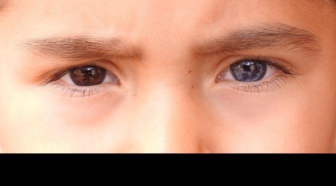 Küçük Hüseyin'in bir gözü mavi diğeri kahverengi