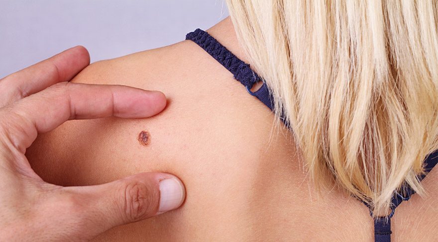 kanser riski tasiyan benlerdeki 6