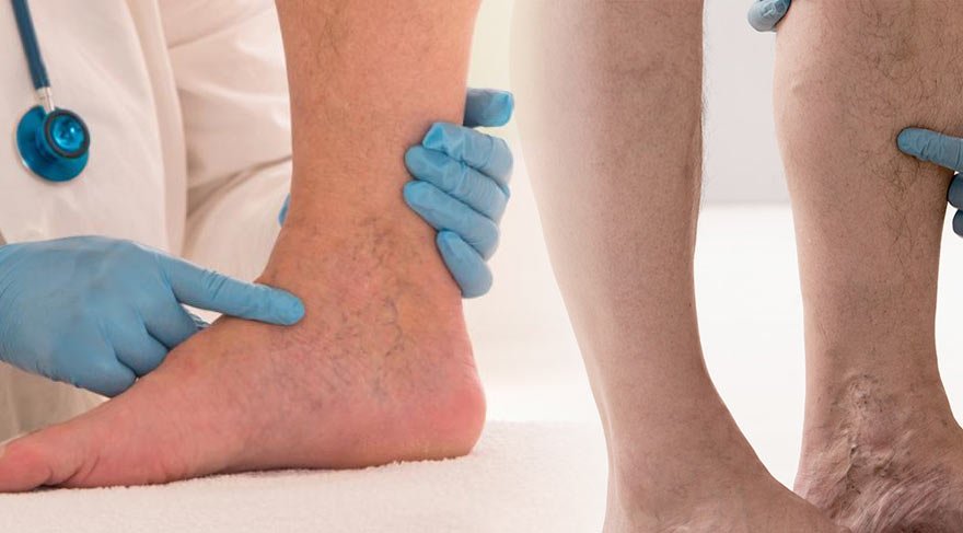 kronik derin ven trombozu belirtileri