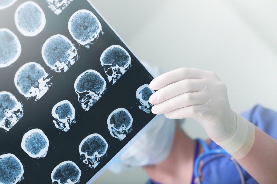Beyin donmasının bilimsel adı "Sphenopalatine ganglioneuralgia"dır.
