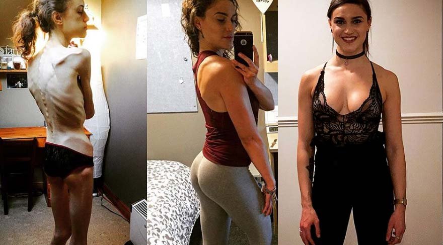 32 kiloya düştü, Instagram sayesinde hayata döndü! Şimdi görenler tanıyamıyor