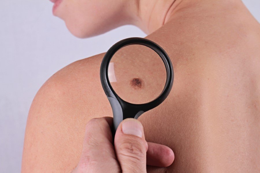 Vücutta var olan bir bende ani gelişen büyüklük, renk ve şekil değişimleri gerçekleşirse, benin şekli asimetrik ve 6 mm'den büyükse, ben üzerinde açık - koyu kahverengi, siyah, kırmızı gibi iki ya da daha fazla renk varsa, ben üzerinde kanama, pürüzlü ve pul pul doku, sulantı ya da iyileşmeyen bir yara oluştuysa, vücuttaki diğer benlere şekil olarak benzemeyen diğerlerinden farklı görünen bir ben fark edilirse, zaman kaybetmeden dermatoloji uzmanına başvurulması gerekmektedir.