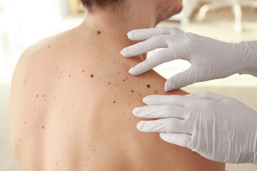 Benlerde meydana gelen ve renk ve şekil değişiklikleri mutlaka önemsenmelidir. Çok sayıda beni olan veya bir beninden şüphelenen kişilerin bir dermatoloji uzmanına başvurup düzenli takiplerini yaptırması çok önemlidir. Ben tanısı ve takibinde dijital dermatoskopi cihazından faydalanılmakta, benler düzenli olarak kontrol edilerek bir önceki kayıtlarla karşılaştırma yapılmaktadır. Bu sayede ben kaynaklı gelişebilecek kötü huylu cilt problemleri de önlenebilmektedir" dedi.
