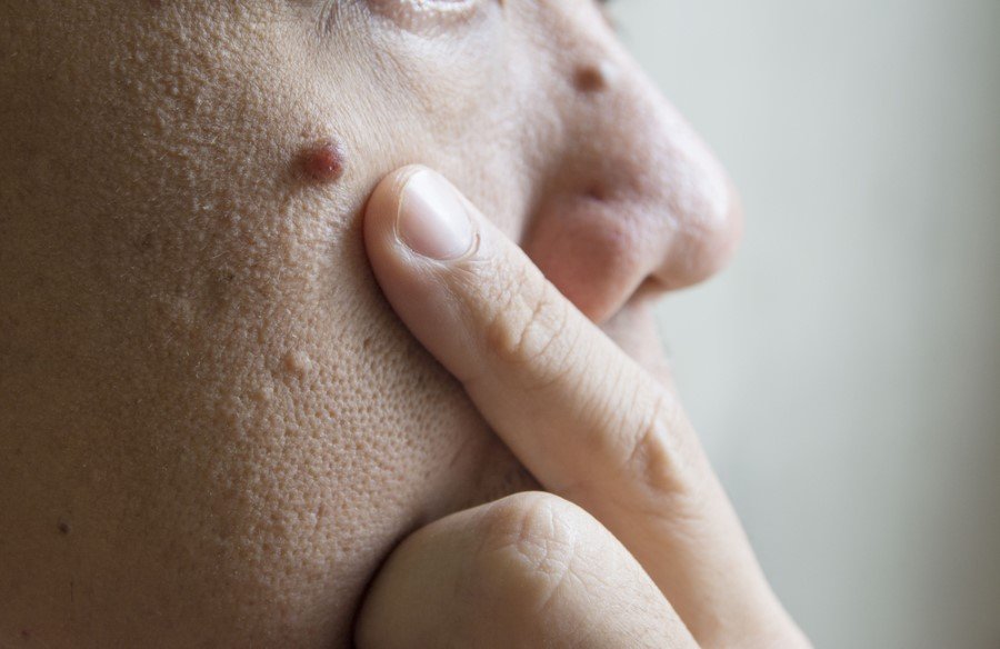 Dermatoloji Uzmanı Dr. Muhammet İsmet Aktaş, benler ve benlerin kanserleşme riskine karşı alınması gereken önlemler hakkında bilgi verdi. Benlerdeki değişikliklerle ilgili uyarılarda bulunan Aktaş, bazı değişikliklerinin ise tehlikeli olabileceğini ifade etti.