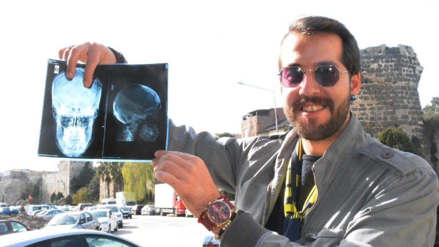 Tomografisi çekildi şoke oldu! Beyninde diş çıktı