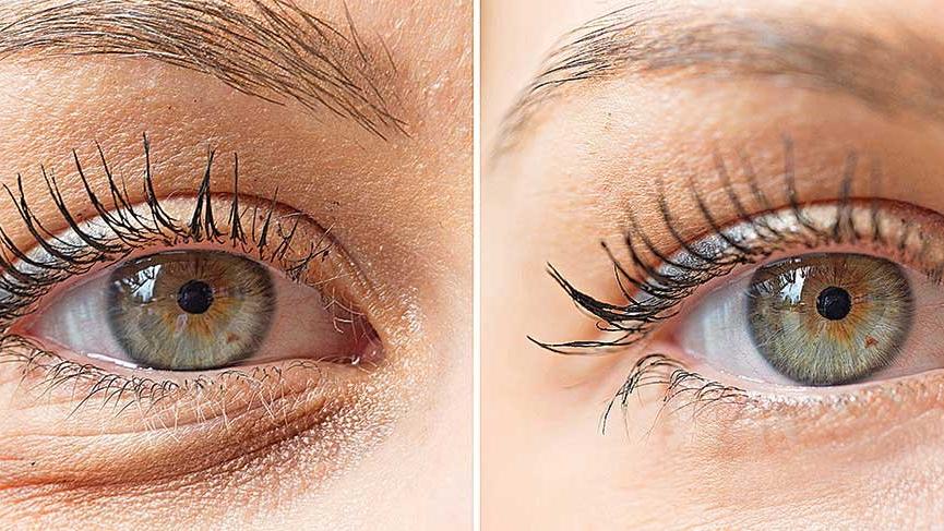 goz alti torbalari nasil gecer