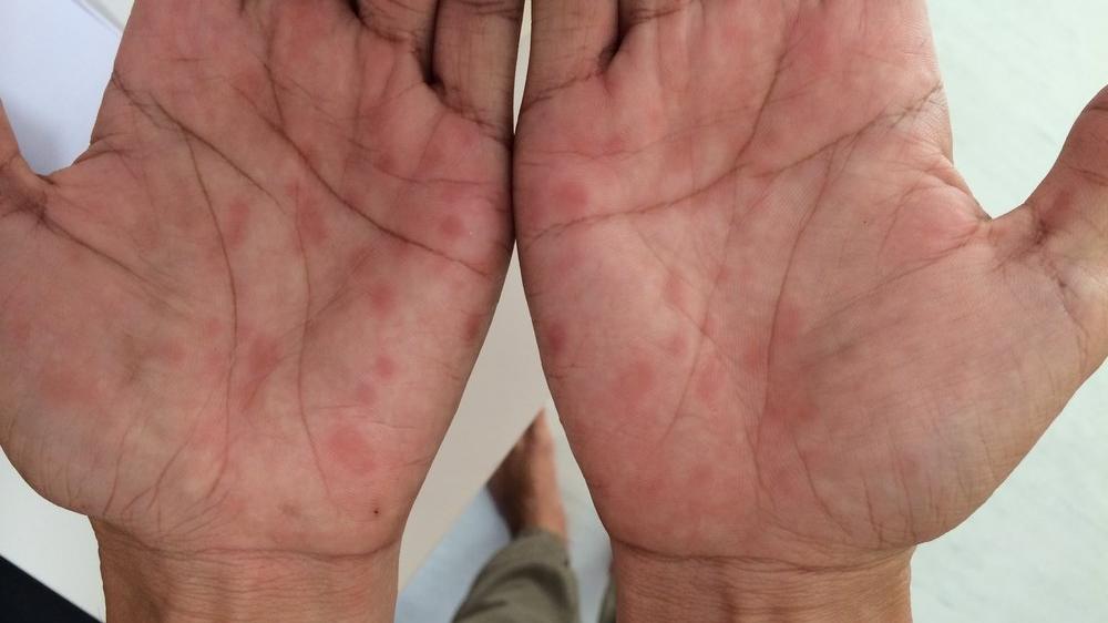 tedavi edilir frengi sifiliz