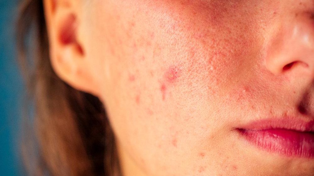 nedenleri belirtileri ve tedavisi