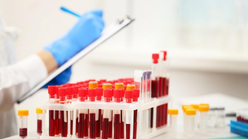 glu glikoz nedir glikoz yuksekligi ve