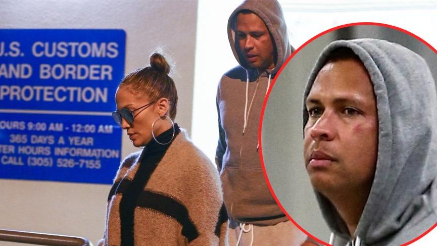 Alex Rodriguez’in yüzündeki morluk dikkat çekti