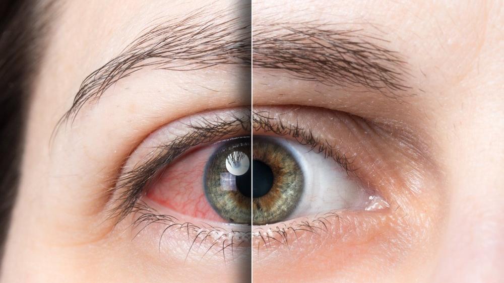 kolobom nedir kolobom nedenleri