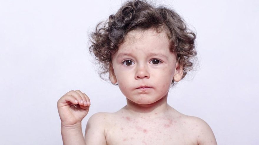 UNICEF: Kızamık vakaları yılın ilk 3 ayında yüzde 300 arttı