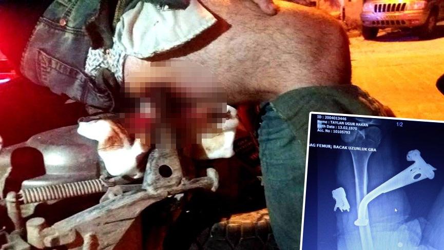 Bacağına saplanan motosiklet ayaklığı, ameliyatla çıkarıldı