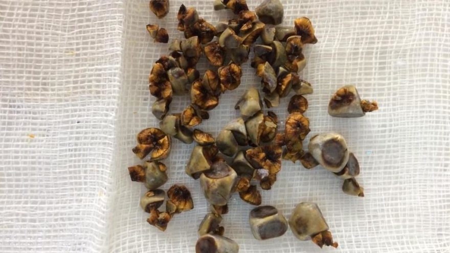 Tersine ameliyat… Ayna yöntemi ile böbrek taşları çıkartıldı