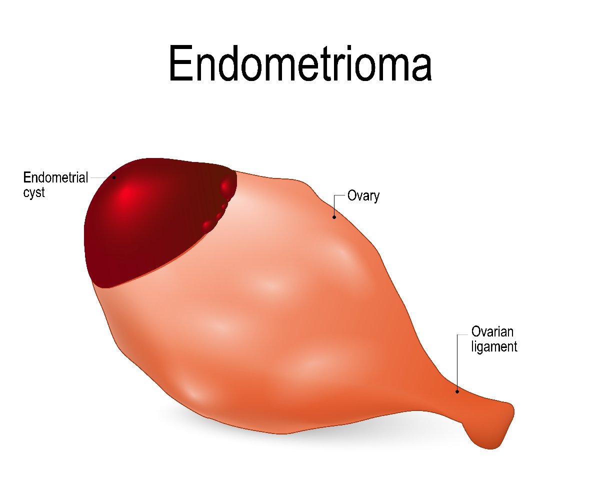 Çikolata kisti (Endometrioma) nedir? Belirtileri ve tedavisi… Sağlık