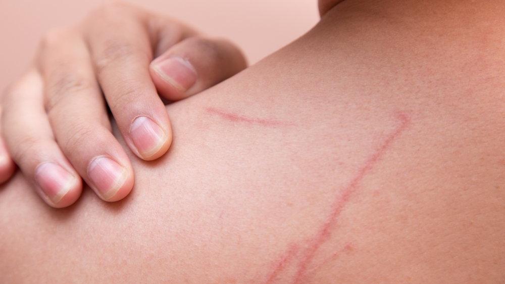 tetanoz asisi ne zaman yapilir