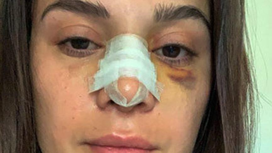 Sunucu Büşra Sanay burnunun kırıldığını sosyal medyadan duyurdu
