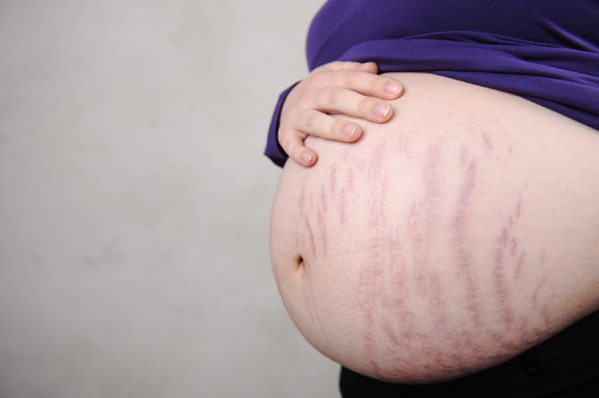 hamilelik catlaklari ne zaman baslar gebelikte vucutta neden catlaklar olur guncel yasam haberleri