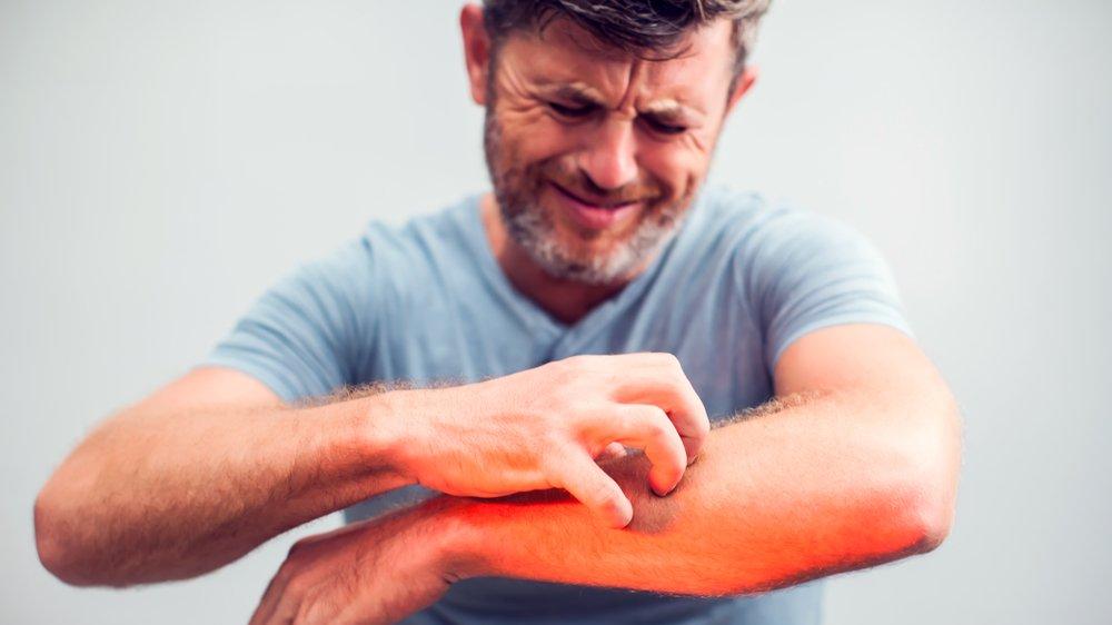 uyuz tedavisi nasil yapilir bitkisel