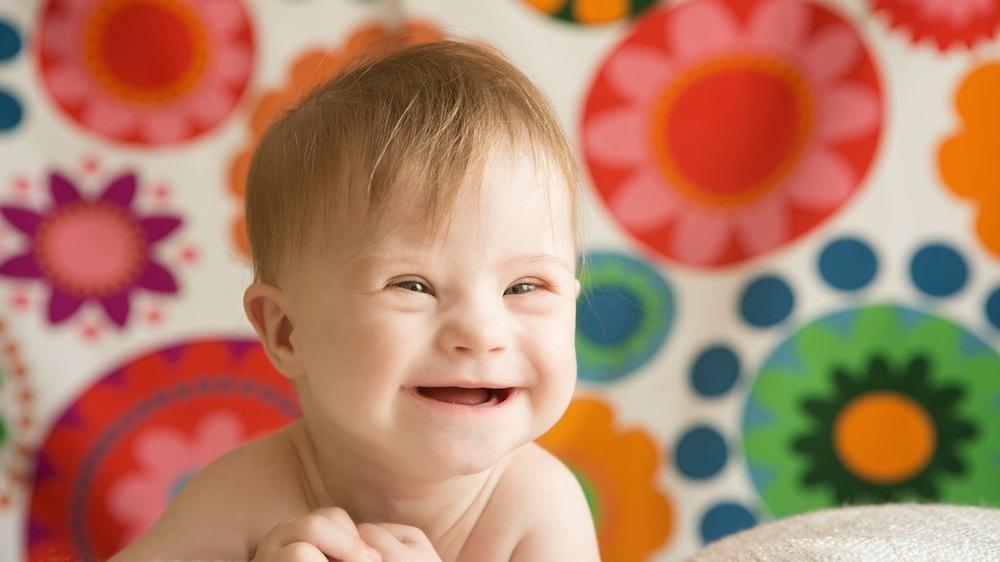 down sendromu belirtileri nelerdir