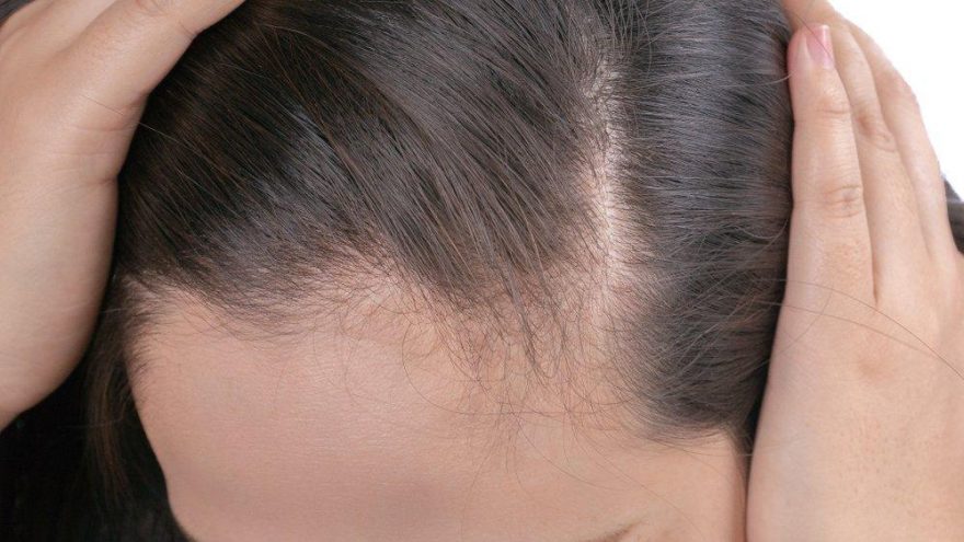 Saçkıran tedavisi nasıl yapılır? Saçkıran ne kadar sürede geçer
