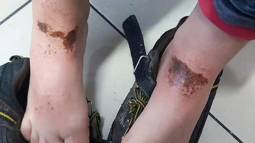 Karla oynarken vücutlarında yanık oluşan 2 çocuğa doku nakli yapılacak
