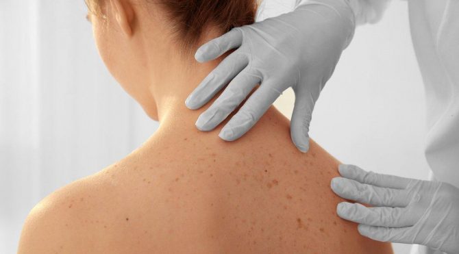 cilt kanseri belirtileri nelerdir saglik son dakika haberler