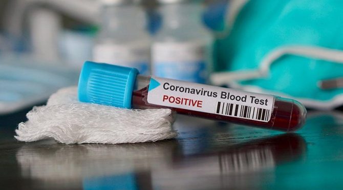 Koronavirus Testi Yapma Kriterleri Genisletildi Daha Cok Kisiye Uygulanacak Saglik Son Dakika Haberler