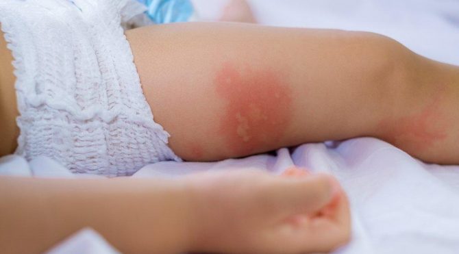 bebeklerde sut alerjisi belirtileri nelerdir guncel yasam haberleri