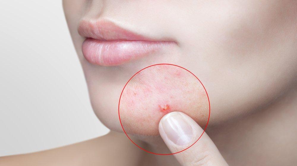 kistik akne nedir kistik akne neden