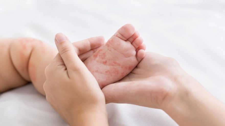 Kızamık nedir, neden olur? Kızamık belirtileri ve tedavisi…