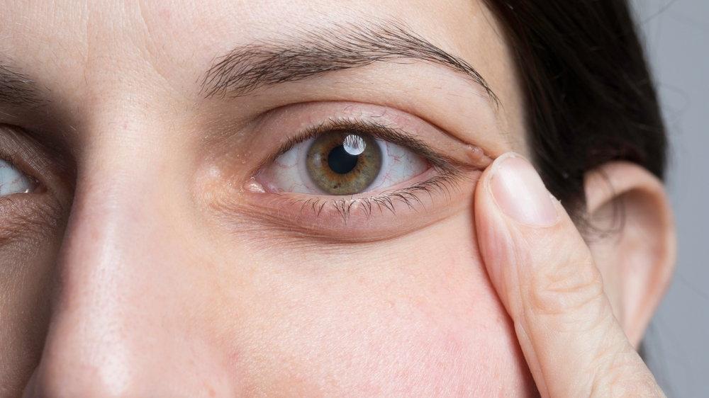 yuzdeki sigil nasil tedavi edilir