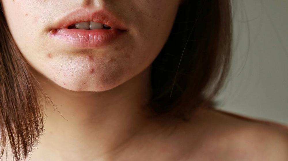 cenedeki beyaz noktalar nasil gecer