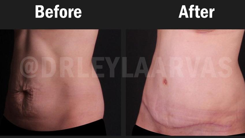 Liposuction Yag Aldirma Yaptirmadan Izle Youtube