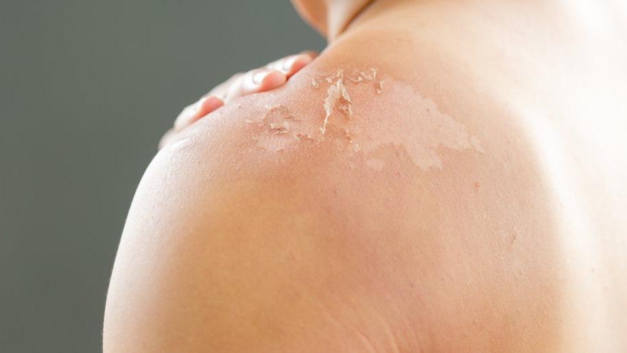 pul pul dokulen cilt nasil tedavi