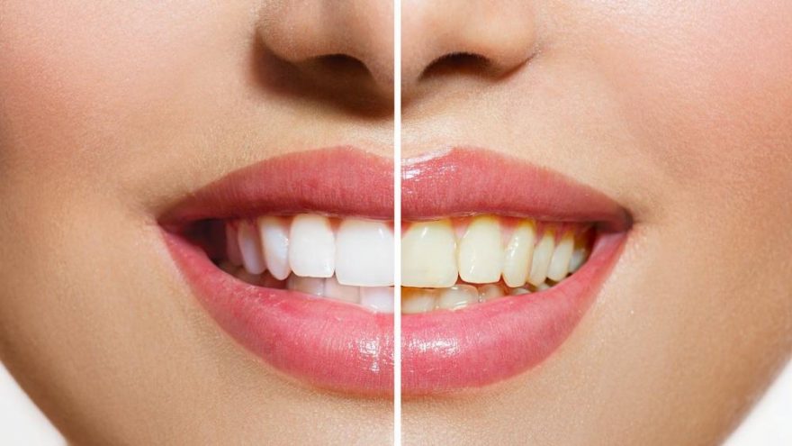 Dişlerde sararmalara karşı günlük bakım önerileri…