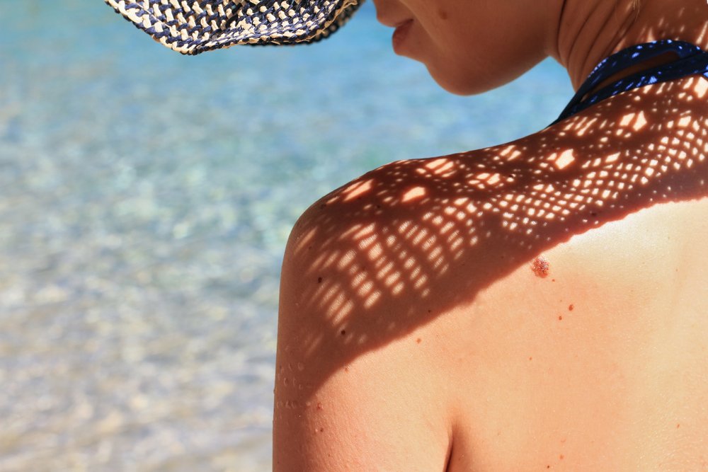 Güneş lekeleri çok hızlı oluşabilir </br></br> Güneş lekeleri veya tıptaki adıyla ‘melasma’ da yazın ortaya çıkan bir diğer önemli dermatolojik sorundur. En sık güneş maruziyeti nedeniyle oluşan güneş lekeleri gebelik, doğum kontrol hapları, hormon replasman tedavileri, bazı kozmetik ürünlerin kullanımı ve genetik yatkınlıkla da ortaya çıkabiliyor. Güneş lekeleri oluşum nedenine göre hızlı bir şekilde oluşabilir ya da zamanla koyuluğu artmaya devam edebilir. Günümüzde birçok leke açmaya yönelik medikal içerikli kremler, peeling, dermapen, mezoterapi yöntemleri ve ‘Q anahtarlı Nd: yağ lazer’ gibi tedavi seçenekleri bulunmaktadır. Cildinizi korumak ve gerekli durumlarda tedavi uygulanması için bir uzmandan destek almanız gerekmektedir.