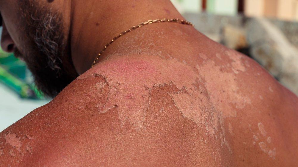 gunes yanigi soyulmasina ne iyi gelir