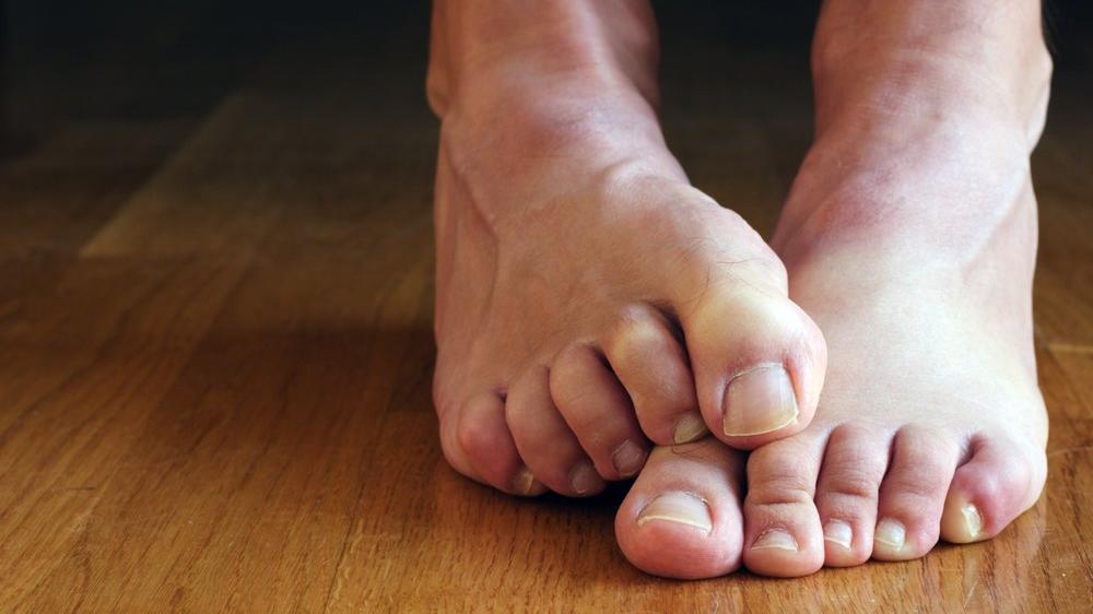 ayak burkulmasina ne iyi gelir bitkisel tedavi yontemleri nelerdir guncel yasam haberleri