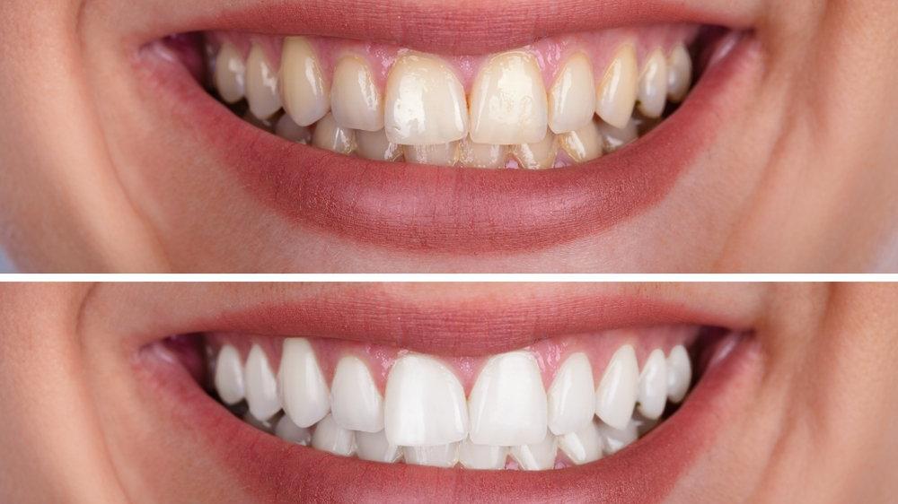 dis renginde sararma neden olur nasil