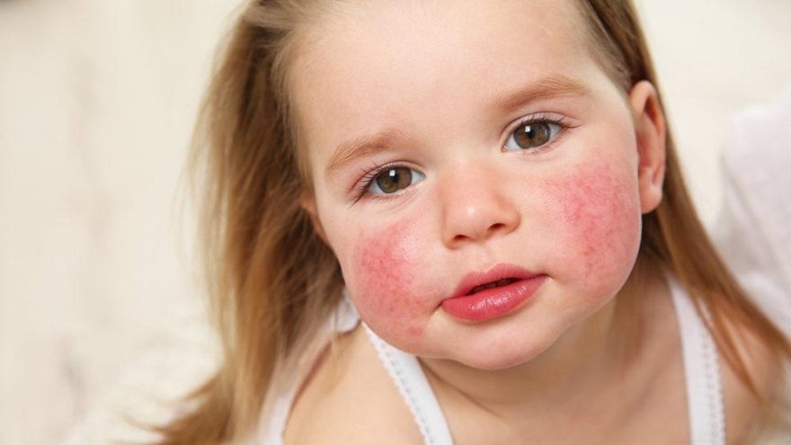 bebeklerde besin alerjisi belirtileri nelerdir guncel yasam haberleri