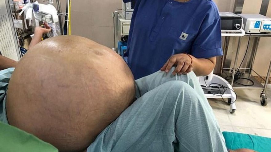 Tıp dünyası şokta: 107 kiloluk tümör çıktı